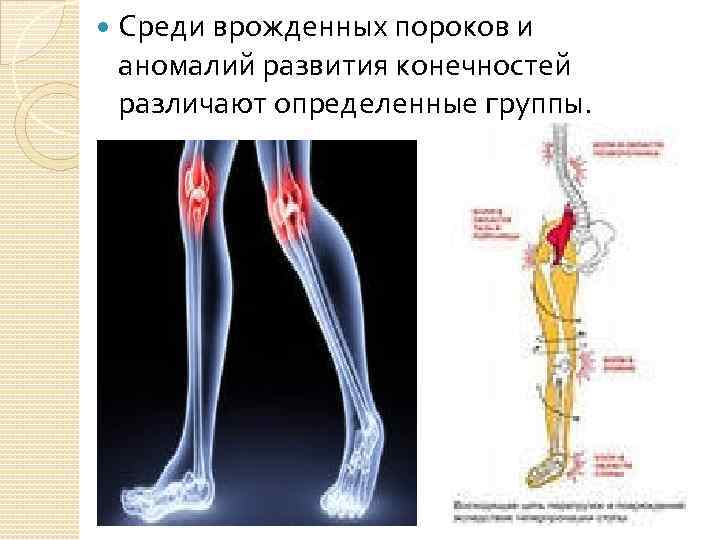  Среди врожденных пороков и аномалий развития конечностей различают определенные группы. 