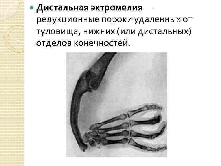  Дистальная эктромелия — редукционные пороки удаленных от туловища, нижних (или дистальных) отделов конечностей.