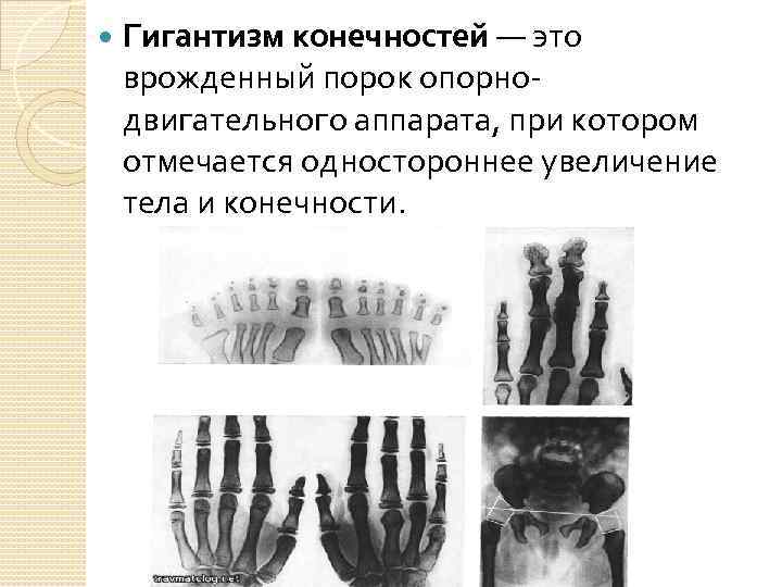  Гигантизм конечностей — это врожденный порок опорно двигательного аппарата, при котором отмечается одностороннее