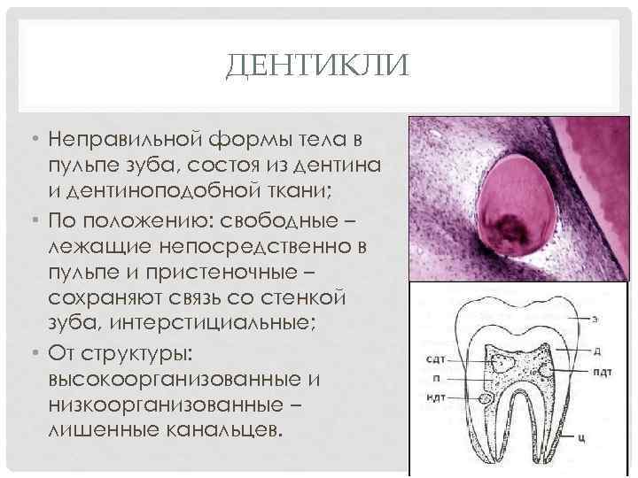 ДЕНТИКЛИ • Неправильной формы тела в пульпе зуба, состоя из дентина и дентиноподобной ткани;