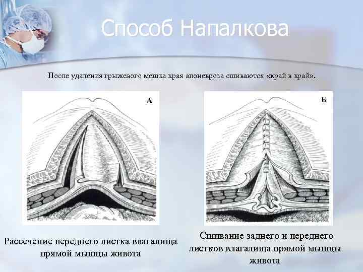 Способ Напалкова После удаления грыжевого мешка края апоневроза сшиваются «край в край» . Сшивание