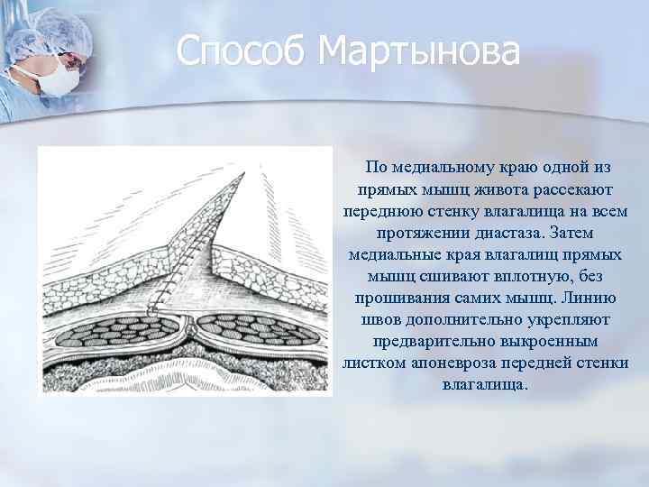 Способ Мартынова По медиальному краю одной из прямых мышц живота рассекают переднюю стенку влагалища