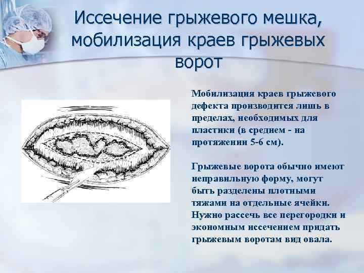 Иссечение грыжевого мешка, мобилизация краев грыжевых ворот Мобилизация краев грыжевого дефекта производится лишь в