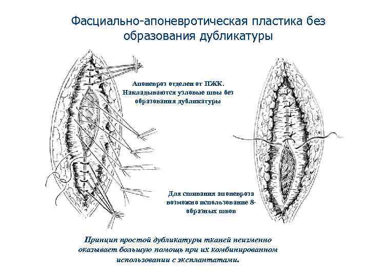 Фасциально-апоневротическая пластика без образования дубликатуры Апоневроз отделен от ПЖК. Накладываются узловые швы без образования