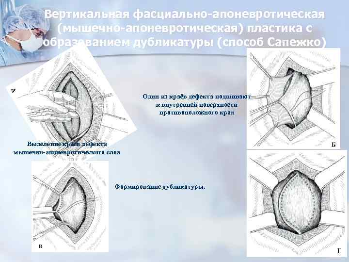 Вертикальная фасциально-апоневротическая (мышечно-апоневротическая) пластика с образованием дубликатуры (способ Сапежко) Один из краёв дефекта подшивают