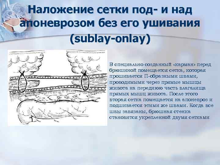 Наложение сетки под- и над апоневрозом без его ушивания (sublay-onlay) В специально созданный «карман»