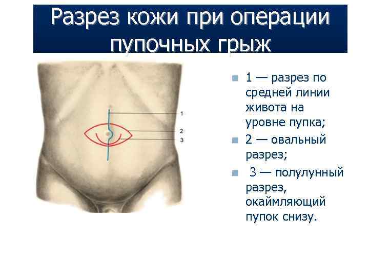 Разрез кожи при операции пупочных грыж n n n 1 — разрез по средней