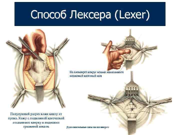 Способ Лексера (Lexer) На апоневроз вокруг кольца накладывают шелковый кисетный шов Полулунный разрез кожи