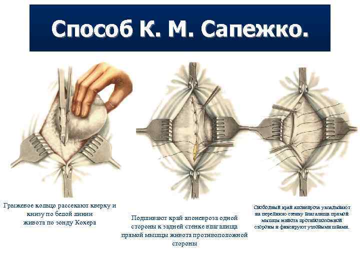 Способ К. М. Сапежко. Грыжевое кольцо рассекают кверху и книзу по белой линии живота