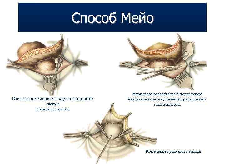 Способ Мейо Отслаивание кожного лоскута и выделение шейки грыжевого мешка. Апоневроз рассекается в поперечном