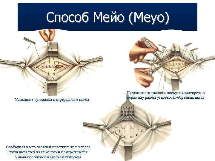 Герниопластика пупочной грыжи. Пупочная грыжа операция по Мейо. Метод по Сапежко и Мейо.