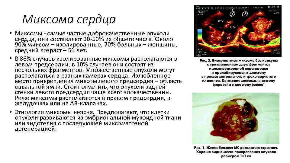 Миксома сердца • Миксомы - самые частые доброкачественные опухоли сердца, они составляют 30 -50%