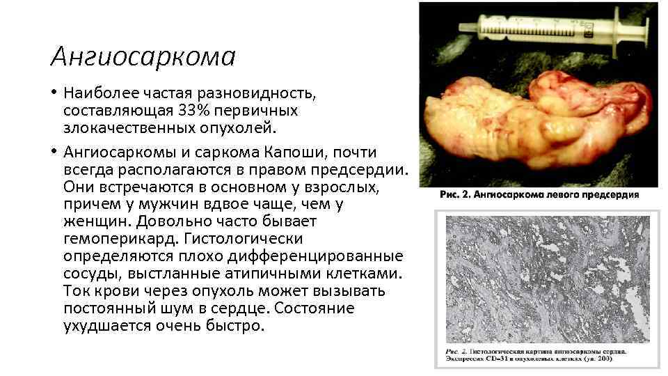 Ангиосаркома • Наиболее частая разновидность, составляющая 33% первичных злокачественных опухолей. • Ангиосаркомы и саркома