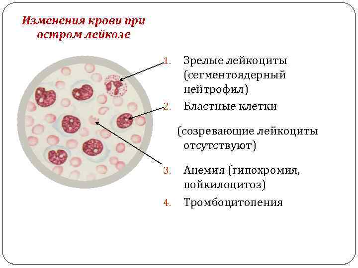 Изменения крови при остром лейкозе Зрелые лейкоциты (сегментоядерный нейтрофил) Бластные клетки 1. 2. (созревающие