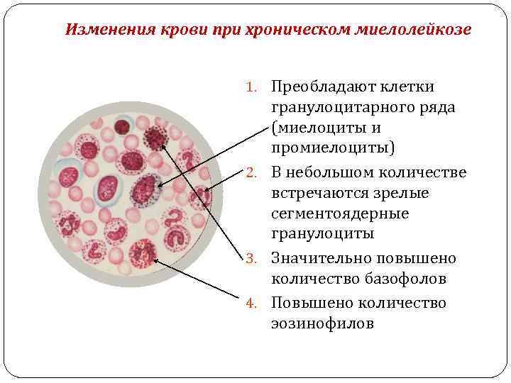 Изменения крови при хроническом миелолейкозе 1. Преобладают клетки гранулоцитарного ряда (миелоциты и промиелоциты) 2.
