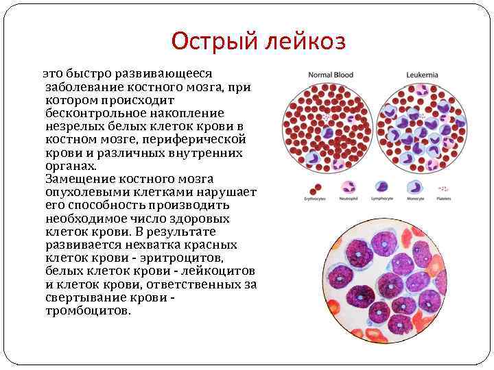 Острый лейкоз это быстро развивающееся заболевание костного мозга, при котором происходит бесконтрольное накопление незрелых