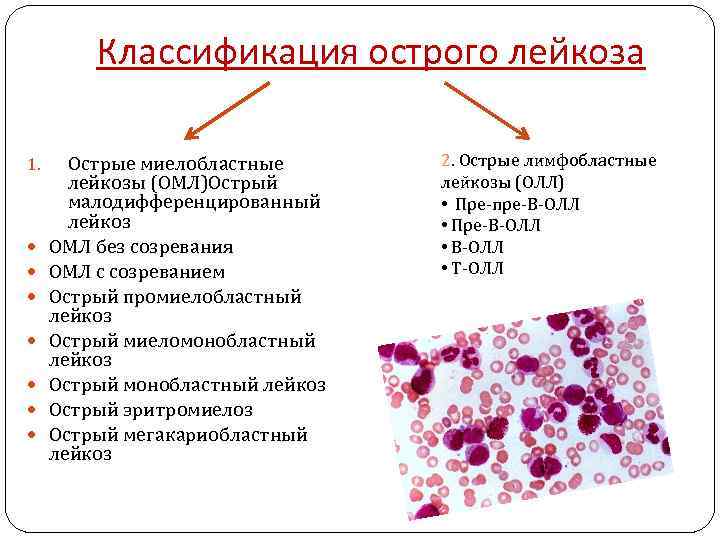 Классификация острого лейкоза 1. Острые миелобластные лейкозы (ОМЛ)Острый малодифференцированный лейкоз ОМЛ без созревания ОМЛ