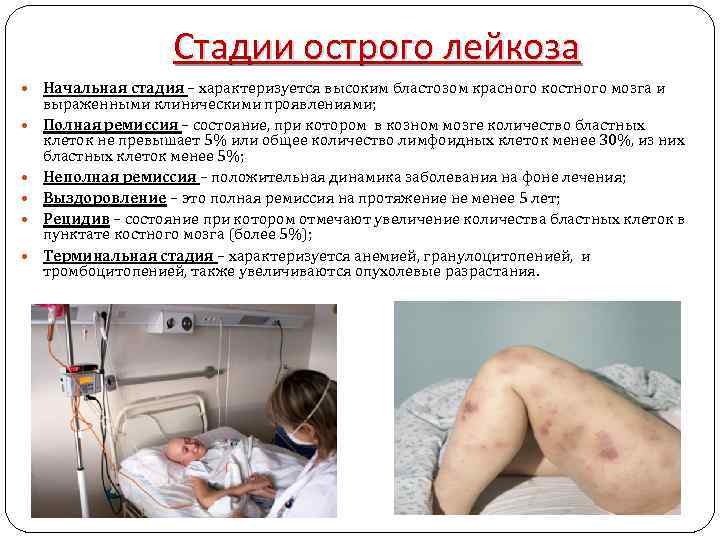 Стадии острого лейкоза Начальная стадия – характеризуется высоким бластозом красного костного мозга и выраженными