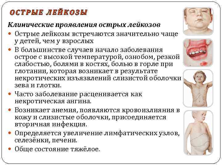 ОСТРЫЕ ЛЕЙКОЗЫ Клинические проявления острых лейкозов Острые лейкозы встречаются значительно чаще у детей, чем
