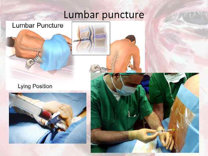 Lumbar puncture 