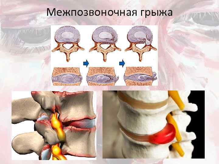 Межпозвоночная грыжа 