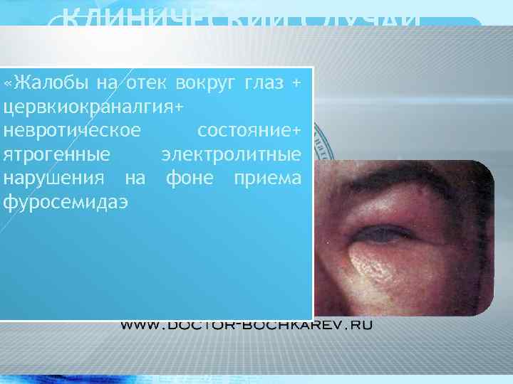 КЛИНИЧЕСКИЙ СЛУЧАЙ E 23. 3 Гипоталамический «Жалобы на отек вокруг глаз + синдром. цервкиокраналгия+