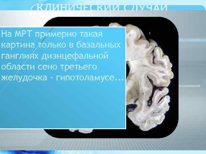 КЛИНИЧЕСКИЙ СЛУЧАЙ E 23. 3 Гипоталамический На МРТ примерно такая синдром. картина только в