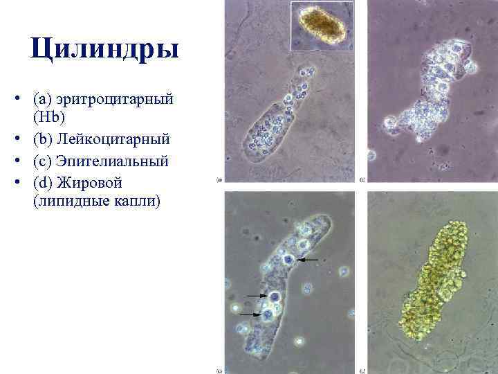 Цилиндры • (a) эритроцитарный (Hb) • (b) Лейкоцитарный • (c) Эпителиальный • (d) Жировой