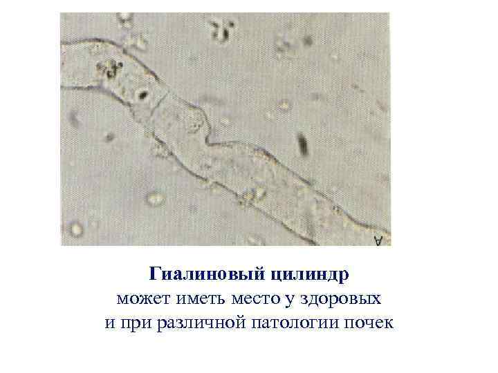 Гиалиновый цилиндр может иметь место у здоровых и при различной патологии почек 