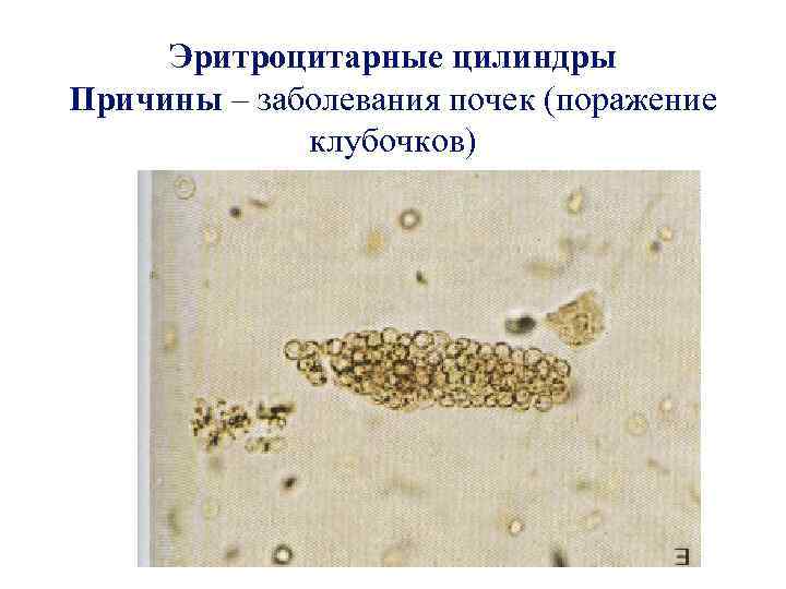 Эритроцитарные цилиндры Причины – заболевания почек (поражение клубочков) 