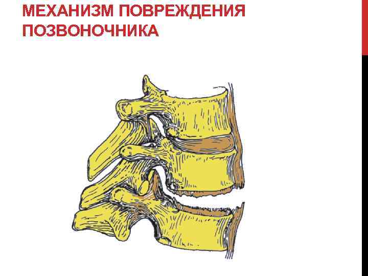 Повреждение позвоночника. Разгибательный механизм повреждения позвоночника. Сгибательный механизм травмы позвоночника. Компрессионный механизм повреждения позвоночника. Механизм компрессионного перелома позвонка.