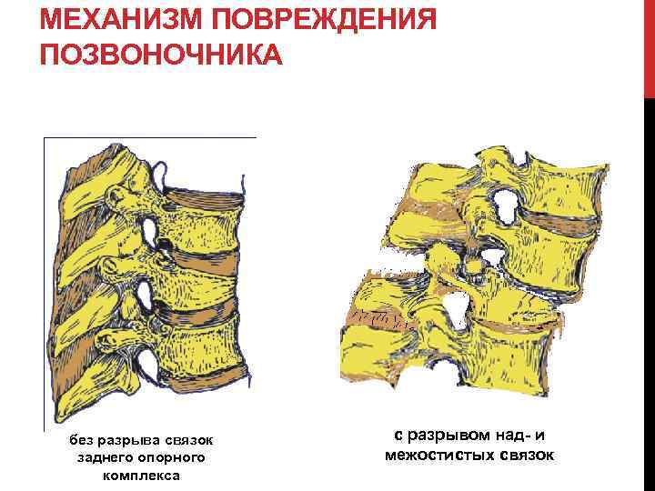 Травмы позвоночника презентация