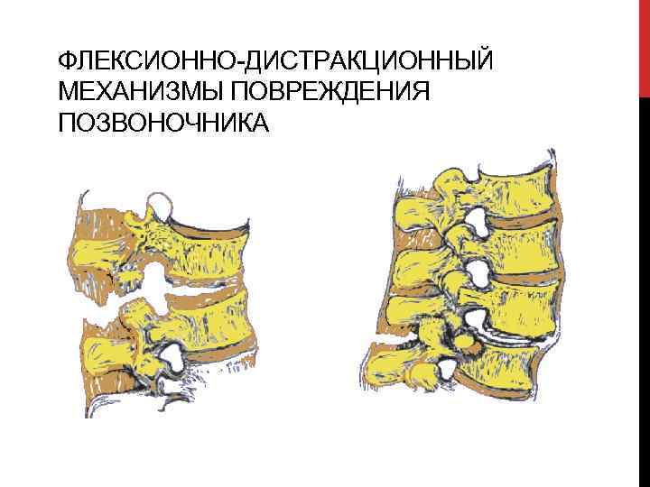 Перелом позвоночника рисунок