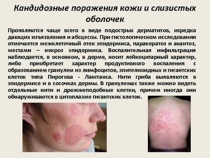 Кандидозные поражения кожи и слизистых оболочек Проявляются чаще всего в виде подострых дерматитов, изредка