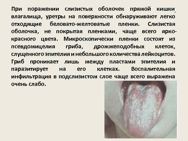 При поражении слизистых оболочек прямой кишки, влагалища, уретры на поверхности обнаруживают легко отходящие беловато-желтоватые