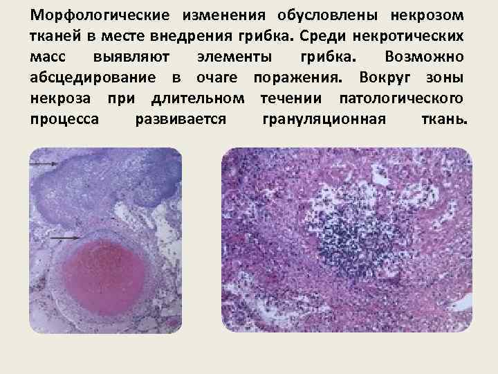 Морфологические изменения обусловлены некрозом тканей в месте внедрения грибка. Среди некротических масс выявляют элементы