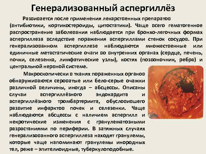 Генерализованный аспергиллёз Развивается после применения лекарственных препаратов (антибиотики, кортикостероиды, цитостатики). Чаще всего гематогенное распространение