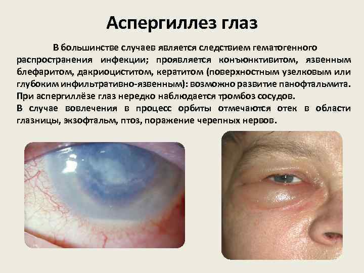 Аспергиллез глаз В большинстве случаев является следствием гематогенного распространения инфекции; проявляется конъюнктивитом, язвенным блефаритом,