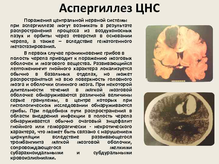 Аспергиллез ЦНС Поражения центральной нервной системы при аспергиллезе могут возникать в результате распространения процесса