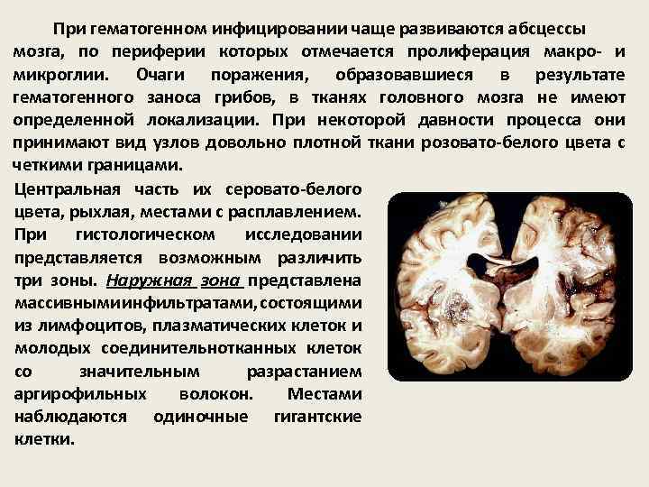 При гематогенном инфицировании чаще развиваются абсцессы мозга, по периферии которых отмечается пролиферация макро- и