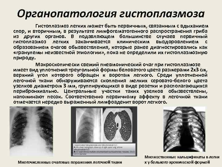 Гистоплазмоз клиническая картина