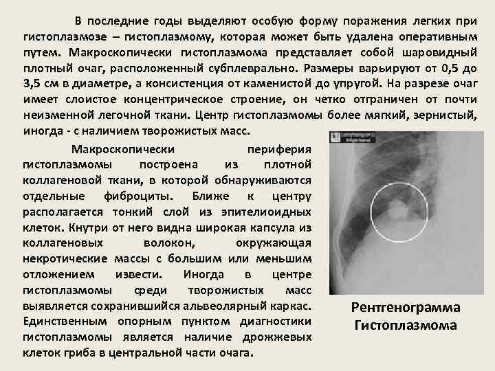  В последние годы выделяют особую форму поражения легких при гистоплазмозе – гистоплазмому, которая