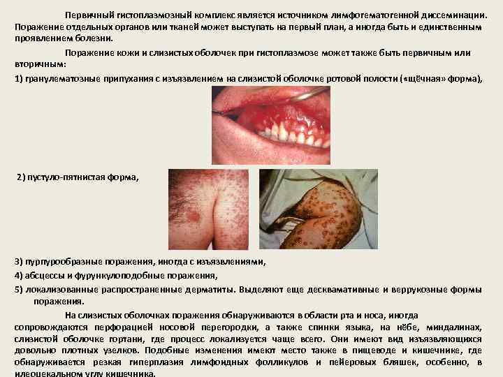 Первичный гистоплазмозный комплекс является источником лимфогематогенной диссеминации. Поражение отдельных органов или тканей может выступать
