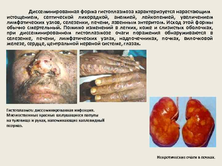 Диссеминированная форма гистоплазмоза характеризуется нарастающим истощением, септической лихорадкой, анемией, лейкопенией, увеличением лимфатических узлов, селезенки,