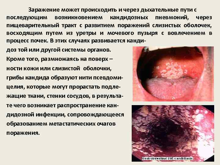 Заражение может происходить и через дыхательные пути с последующим возникновением кандидозных пневмоний, через пищеварительный