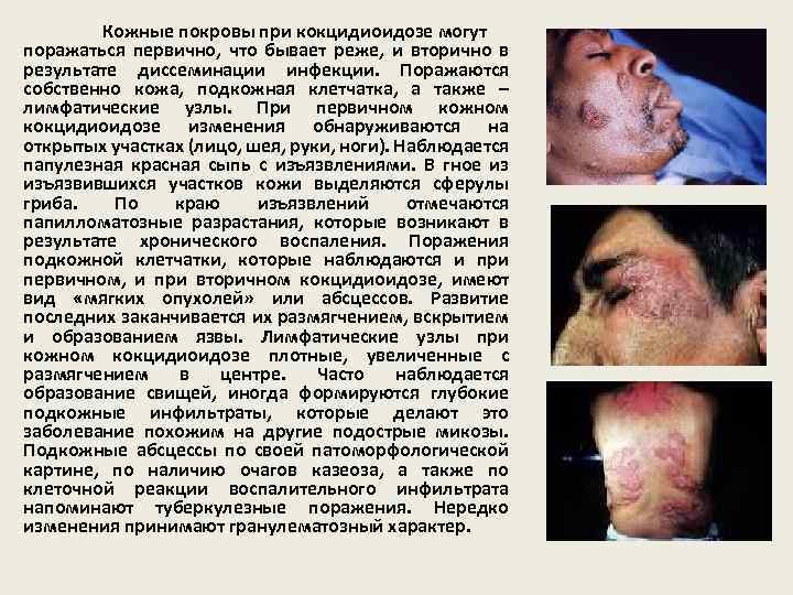 Кожные покровы при кокцидиоидозе могут поражаться первично, что бывает реже, и вторично в результате