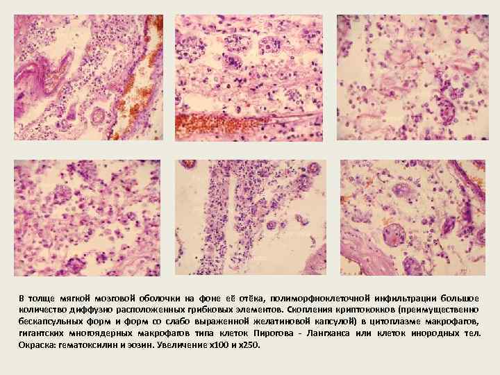 В толще мягкой мозговой оболочки на фоне её отёка, полиморфноклеточной инфильтрации большое количество диффузно