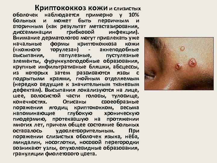 Криптококкоз кожи и слизистых оболочек наблюдается примерно у 10% больных и может быть первичным