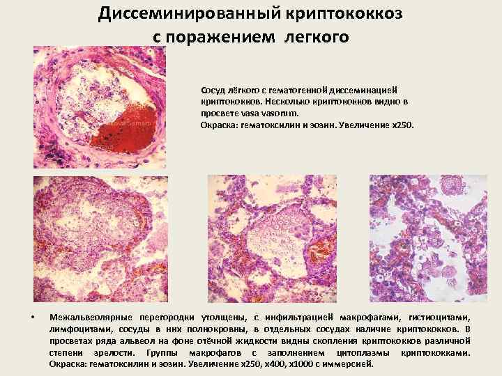 Диссеминированный криптококкоз с поражением легкого Сосуд лёгкого с гематогенной диссеминацией криптококков. Несколько криптококков видно