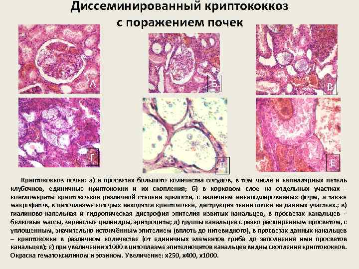 Диссеминированный криптококкоз с поражением почек А Г Б В Д Е Криптококкоз почки: а)